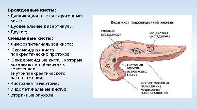 Поджелудочная железа киста лечение