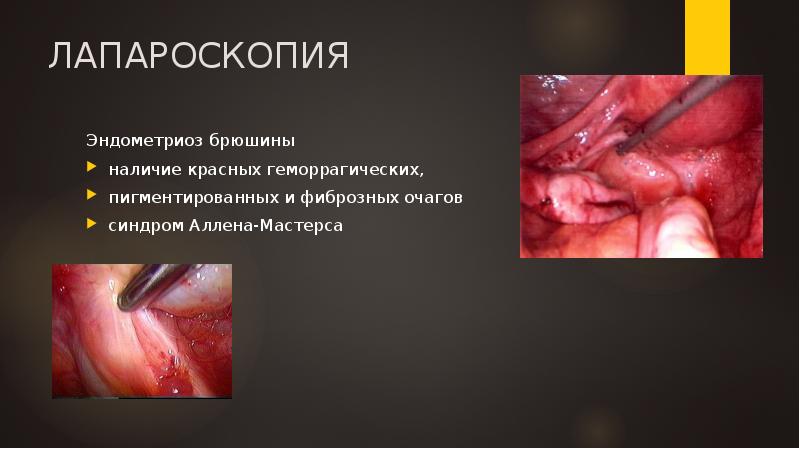 ЛАПАРОСКОПИЯ
Эндометриоз брюшины
наличие красных геморрагических,
пигментированных и фиброзных очагов
cиндром ЛАПАРОСКОПИЯ
Эндометриоз брюшины
наличие красных геморрагических,
пигментированных и фиброзных очагов
cиндром