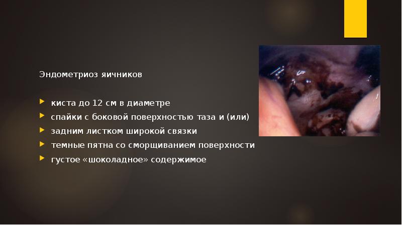 Эндометриоз яичников
киста до 12 см в диаметре
спайки с боковой Эндометриоз яичников
киста до 12 см в диаметре
спайки с боковой