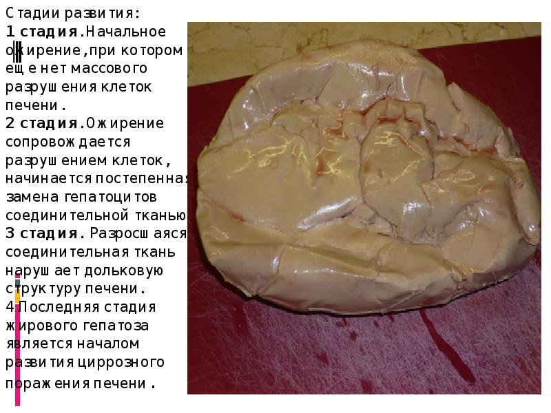 Сердце при ожирении фото