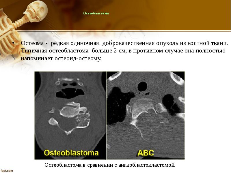 Доброкачественные опухоли костей презентация
