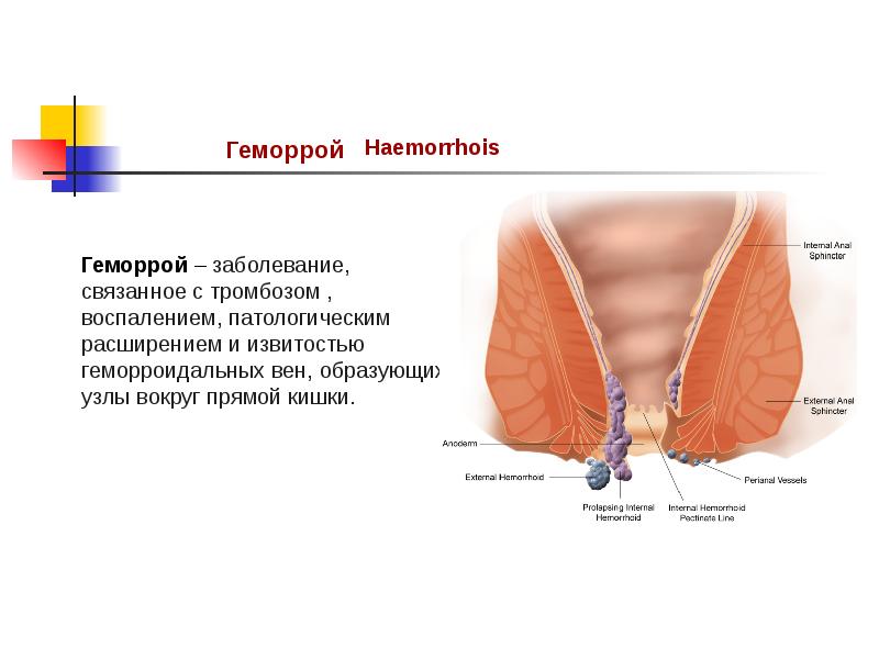 Геморрой презентация хронический