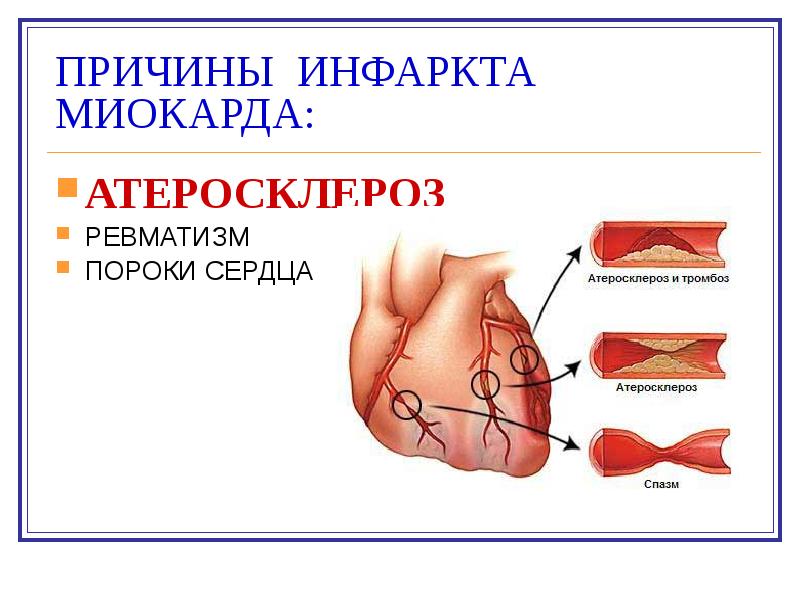 Ибс инфаркт миокарда презентация