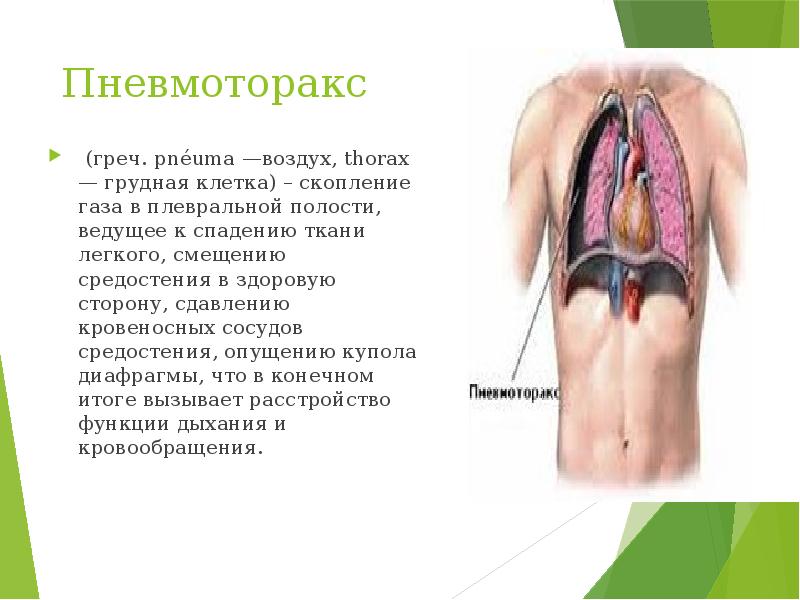 Пневмоторакс &nbsp;(греч. pnéuma —воздух, thorax — грудная клетка) – скопление газа