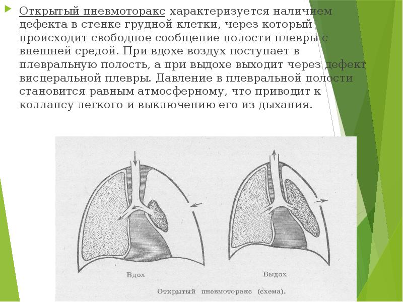 Физикальная картина при пневмотораксе характеризуется