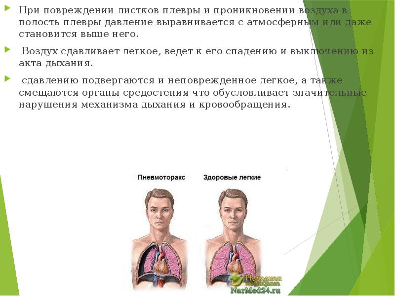 При повреждении листков плевры и проникновении воздуха в полость плевры давление