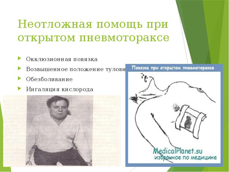Неотложная помощь при открытом пневмотораксе  Окклюзионная повязка Возвышенное положение туловища
