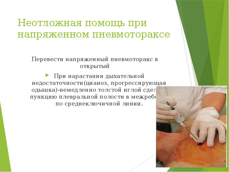 Неотложная помощь при напряженном пневмотораксе Перевести напряженный пневмоторакс в открытый При
