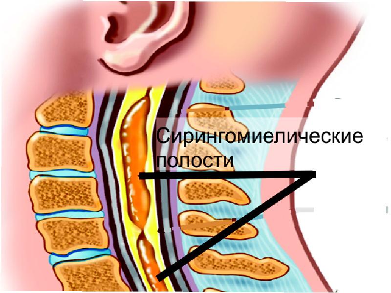 Сирингомиелия презентация по неврологии