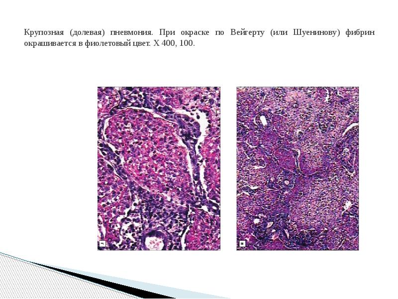Пневмония при колите. Крупозная пневмония окраска гематоксилин и эозин. Окраска по Граму Вейгерту. Крупозная пневмония препарат патанатомия. Окраска по Вейгерту в гистологии.