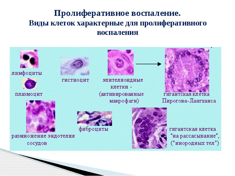 Пролиферативный. Пролиферативное гранулематозное воспаление. Классификация пролиферативного воспаления. Пролиферативное (продуктивное) воспаление. Пролиферативное воспаление патогенез.