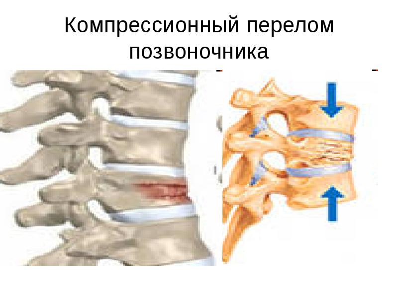 Перелом позвоночника картинки