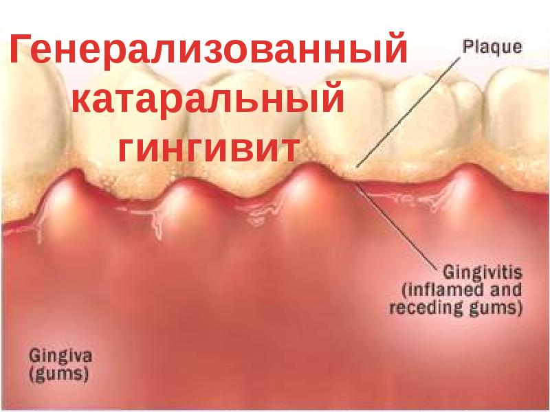 План лечения катарального гингивита