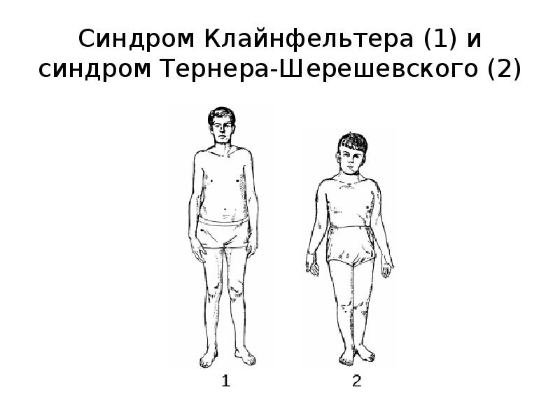 Синдром клайнфельтера картинки