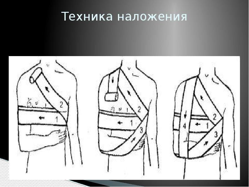 Дезо повязка на плечевой схема