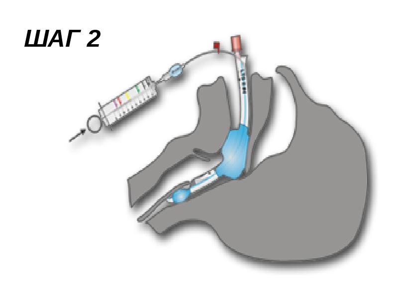 Ларингеальная трубка фото