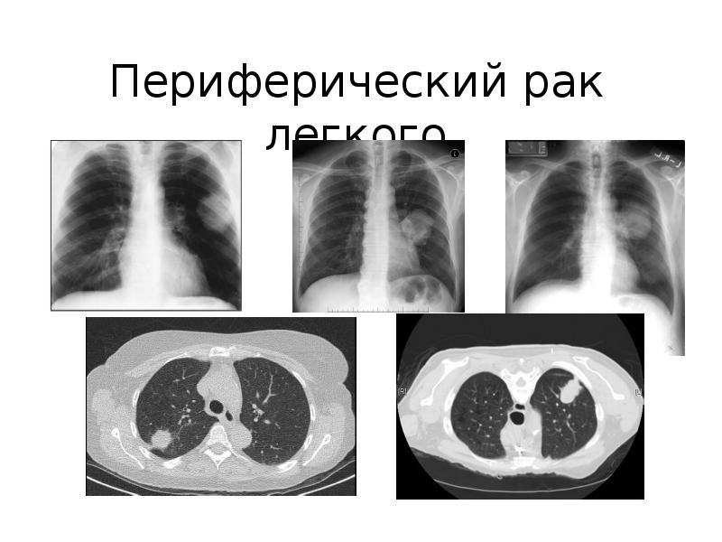 Лучевая картина центрального периферического и метастатического рака легкого