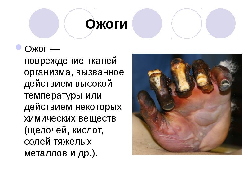 Ожоги
Ожог — повреждение тканей организма, вызванное действием высокой температуры или действием Ожоги
Ожог — повреждение тканей организма, вызванное действием высокой температуры или действием