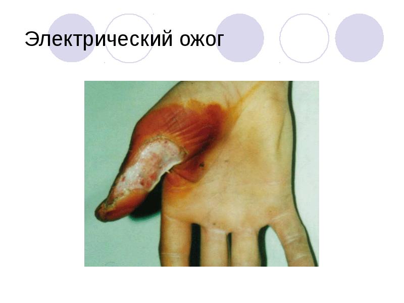 Электрический ожог Электрический ожог
