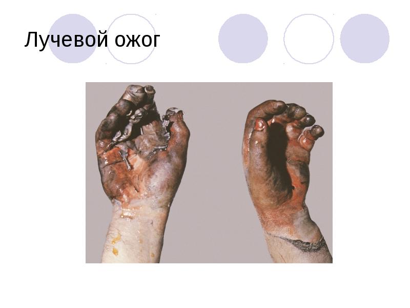 Лучевой ожог Лучевой ожог