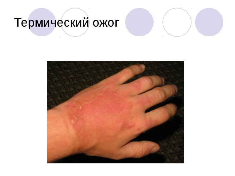 Термический ожог Термический ожог