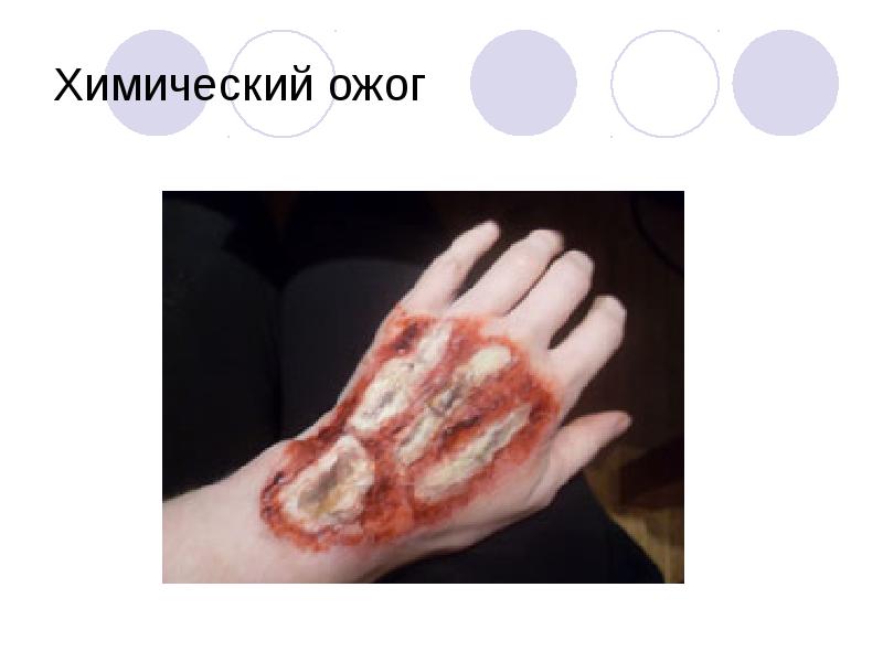 Химический ожог Химический ожог