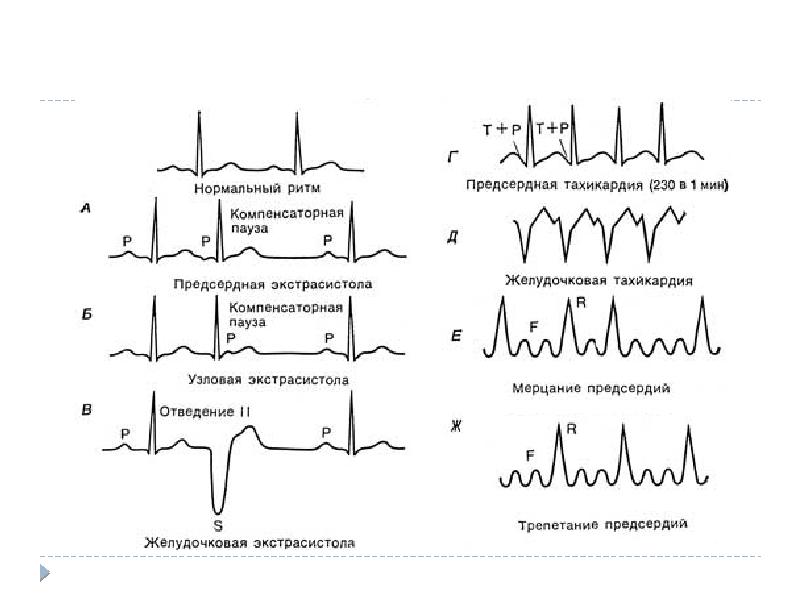 Экг при нарушениях ритма и проводимости презентация