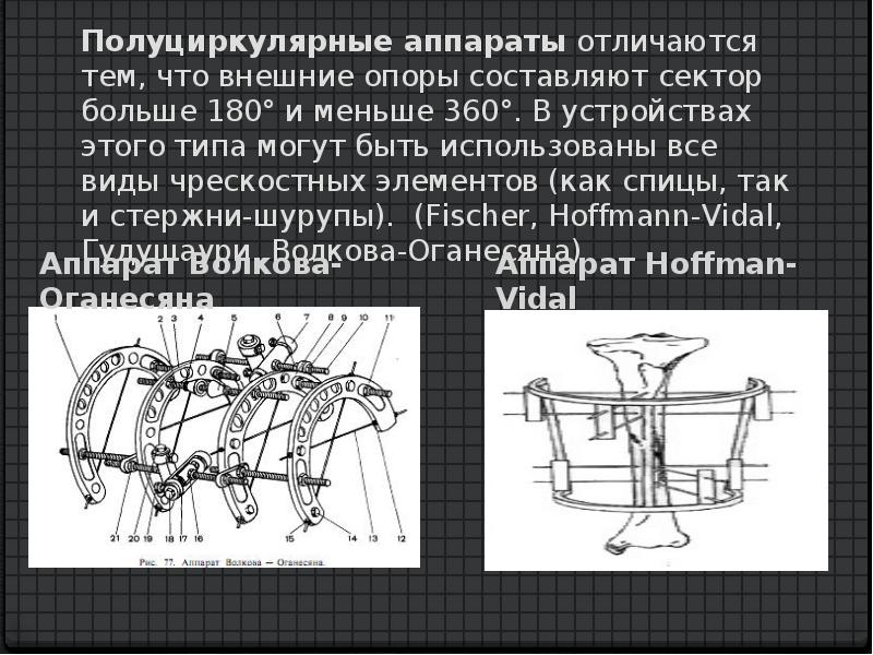 Чем отличаются аппараты. Внеочаговый чрескостный остеосинтез.