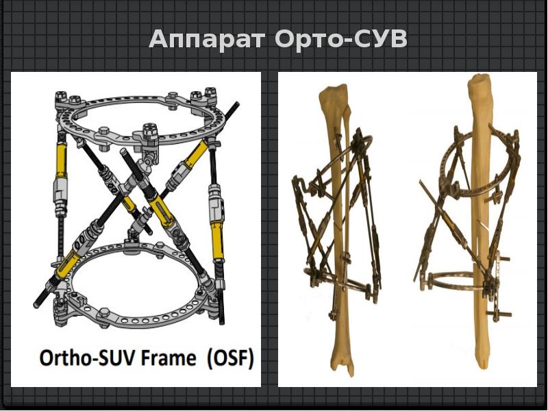 Внеочаговый остеосинтез презентация