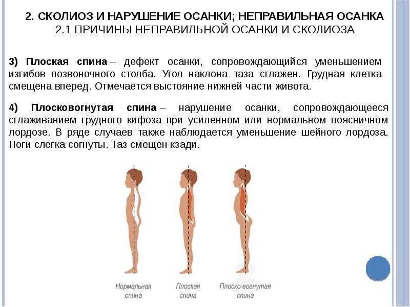 Профилактика сколиоза презентация