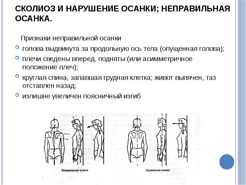 Как называется нарушение осанки изображенное на рисунке 2