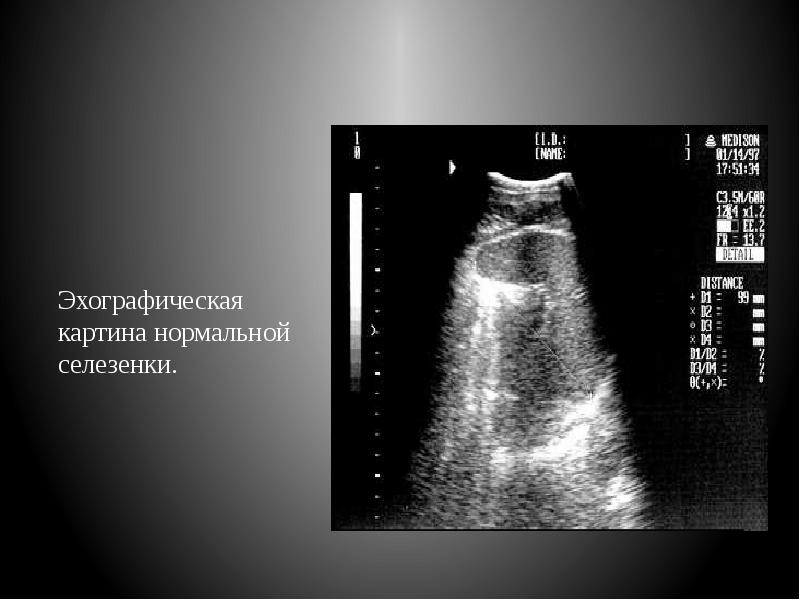 Эхографическая картина. Анатомия желчных протоков УЗИ. Ультразвуковая анатомия желчного пузыря. Ультразвуковая анатомия анатомия желчного пузыря.