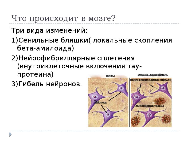 Нейродегенеративные заболевания нервной системы презентация