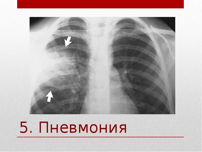 Пневмония 5. Пневмония 5 -8 процентов. Пневмония и 38,5.