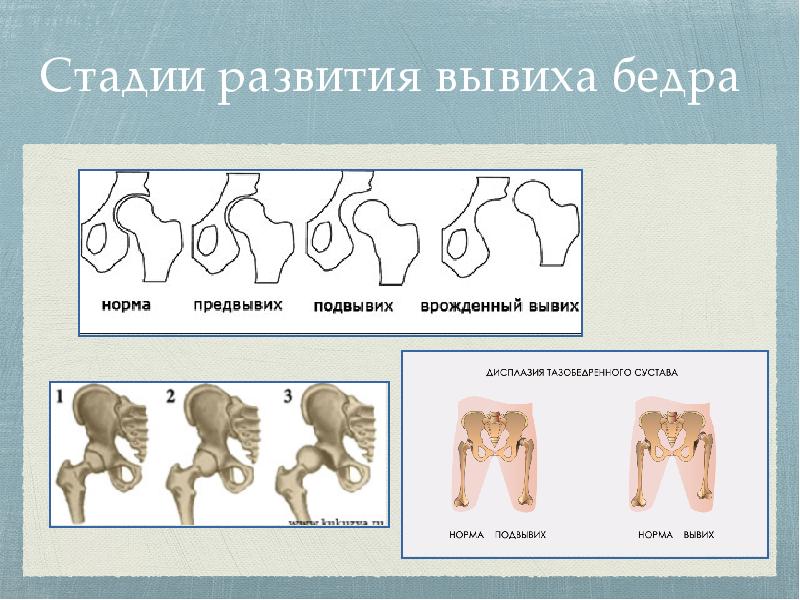 Для клинической картины врожденного вывиха бедра характерны симптомы