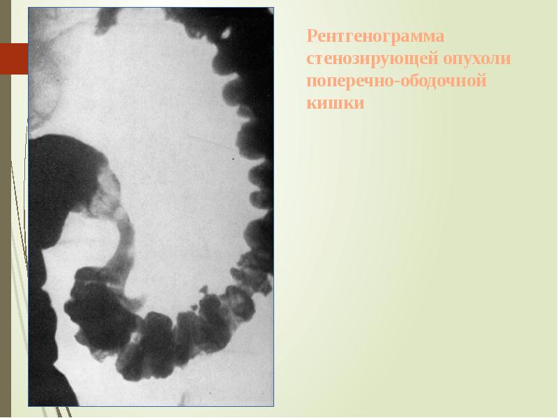 Рентгенограмма стенозирующей опухоли поперечно-ободочной кишки Рентгенограмма стенозирующей опухоли поперечно-ободочной кишки