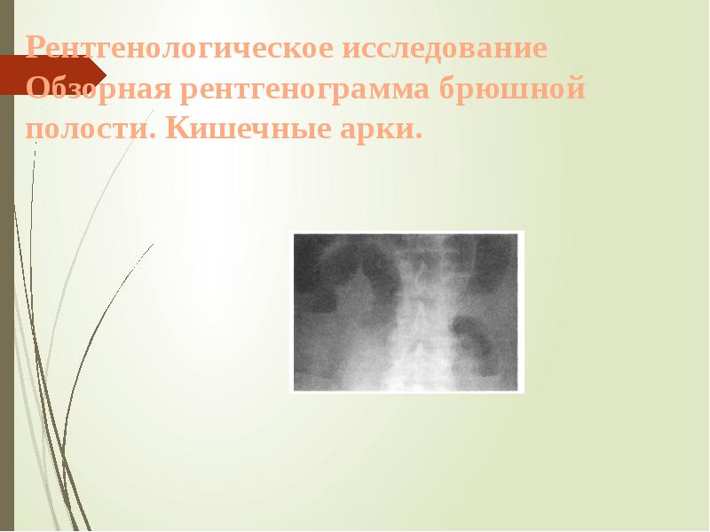 Рентгенологическое исследование Обзорная рентгенограмма брюшной полости. Кишечные арки. Рентгенологическое исследование Обзорная рентгенограмма брюшной полости. Кишечные арки.