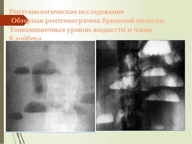 Рентгенологическое исследование Обзорная рентгенограмма брюшной полости. Тонкокишечные уровни жидкости и Рентгенологическое исследование Обзорная рентгенограмма брюшной полости. Тонкокишечные уровни жидкости и