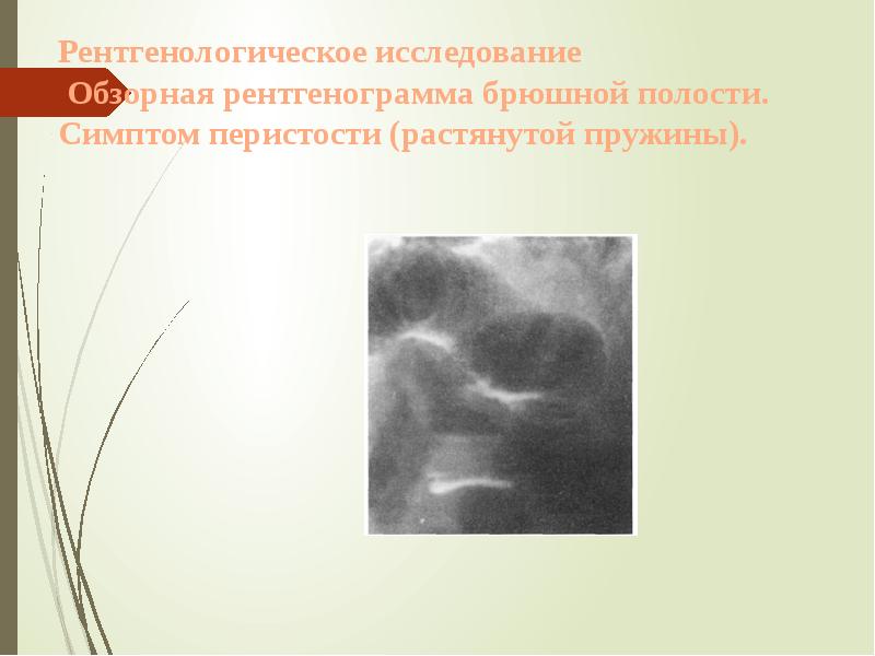 Рентгенологическое исследование Обзорная рентгенограмма брюшной полости. Симптом перистости (растянутой пружины). Рентгенологическое исследование Обзорная рентгенограмма брюшной полости. Симптом перистости (растянутой пружины).