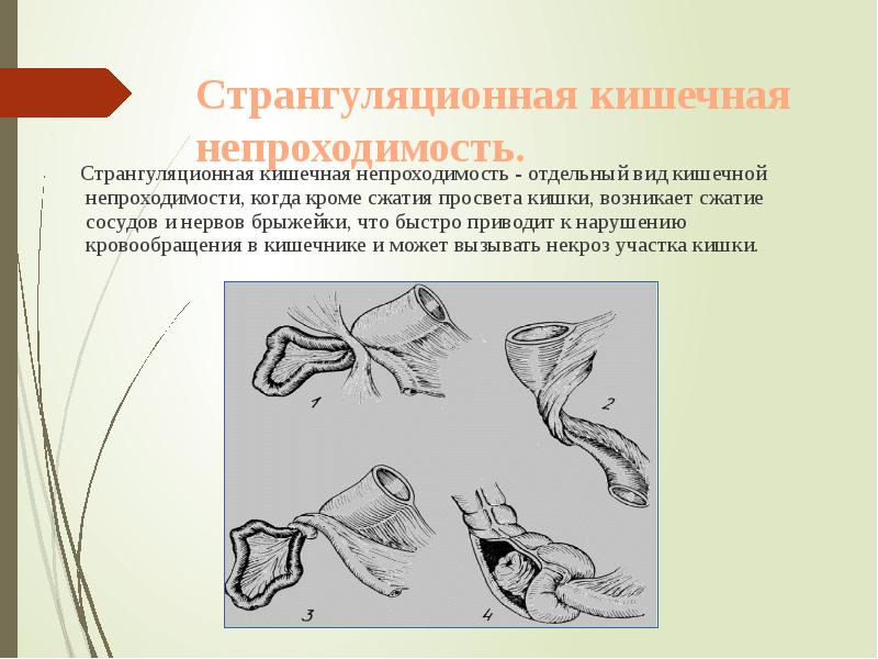 Странгуляционная кишечная непроходимость.
Странгуляционная кишечная непроходимость - Странгуляционная кишечная непроходимость.
Странгуляционная кишечная непроходимость -