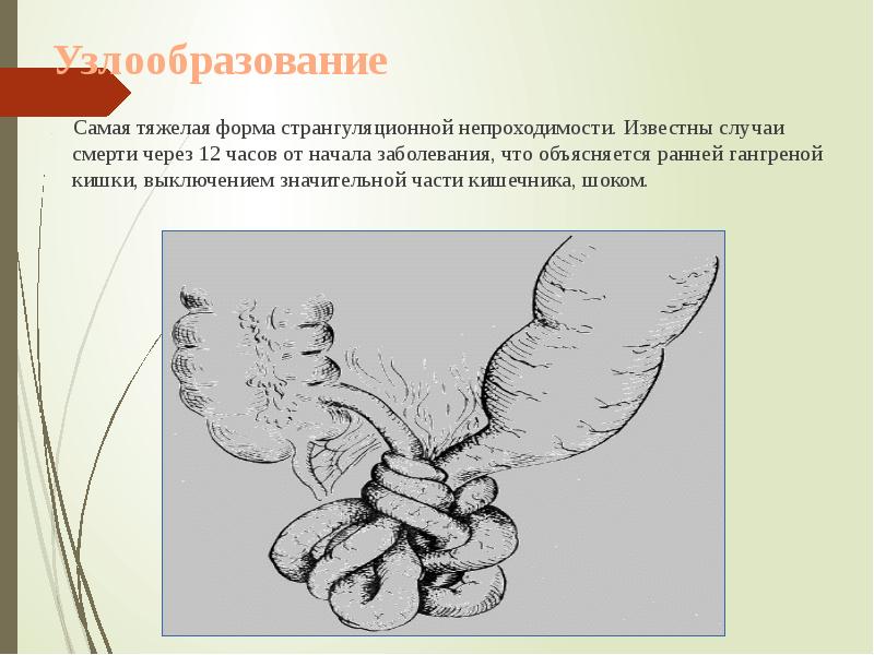 Узлообразование
Самая тяжелая форма странгуляционной непроходимости. Известны Узлообразование
Самая тяжелая форма странгуляционной непроходимости. Известны