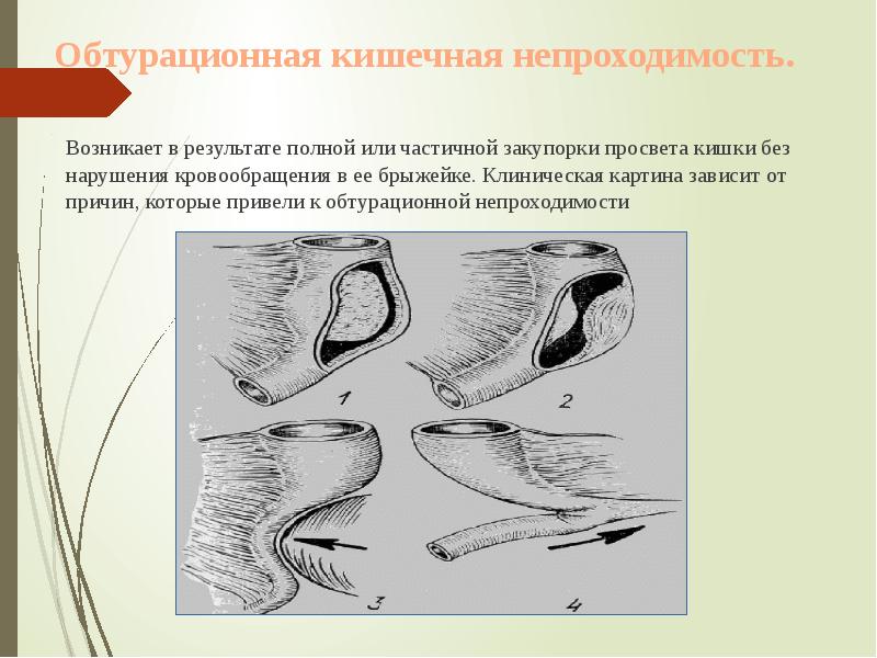 Обтурационная кишечная непроходимость.
Возникает в результате Обтурационная кишечная непроходимость.
Возникает в результате