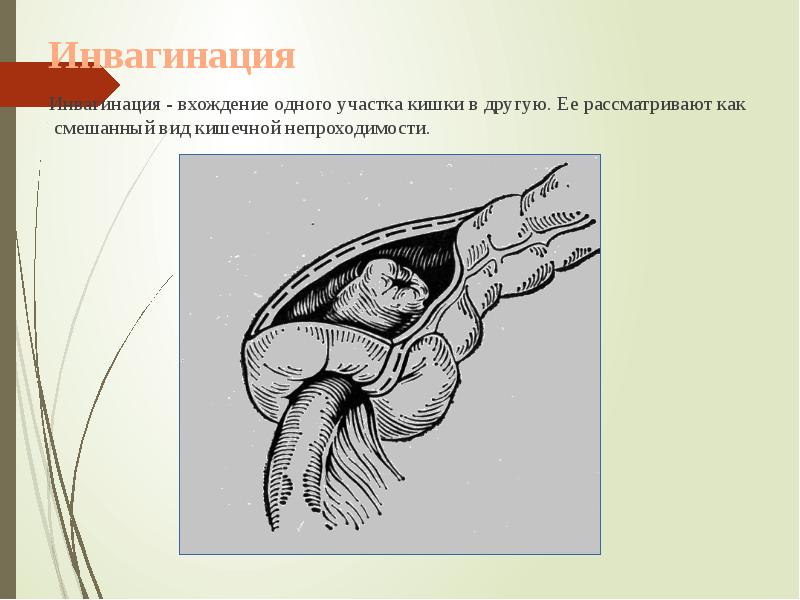 Инвагинация
Инвагинация - вхождение одного участка кишки Инвагинация
Инвагинация - вхождение одного участка кишки