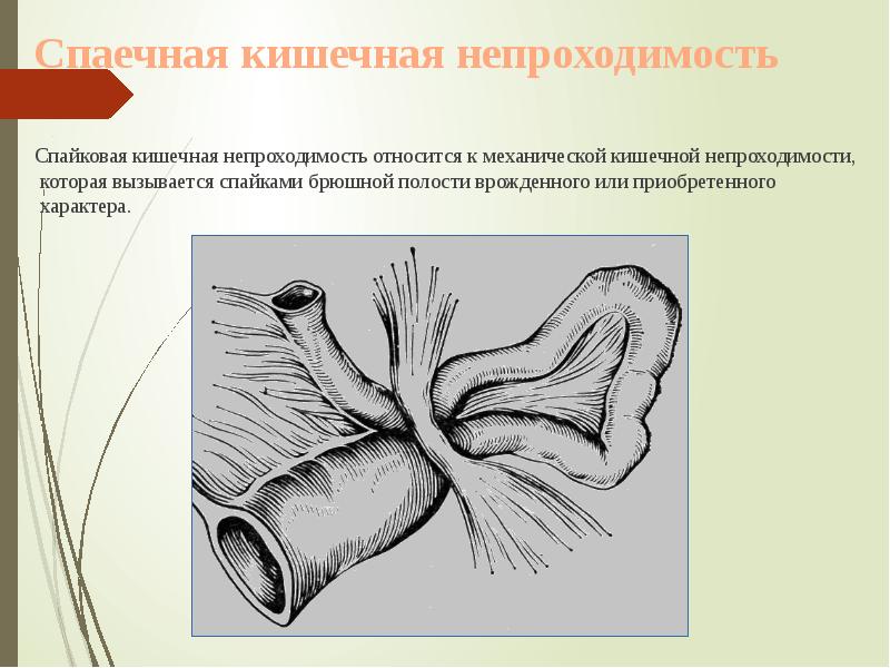 Спаечная кишечная непроходимость
Спайковая кишечная непроходимость относится Спаечная кишечная непроходимость
Спайковая кишечная непроходимость относится