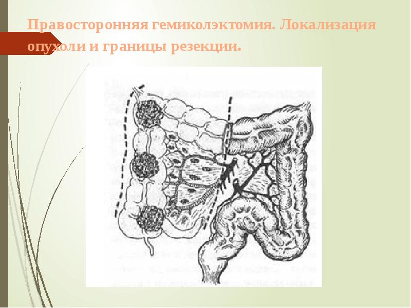 Правосторонняя гемиколэктомия. Локализация опухоли и границы резекции. Правосторонняя гемиколэктомия. Локализация опухоли и границы резекции.