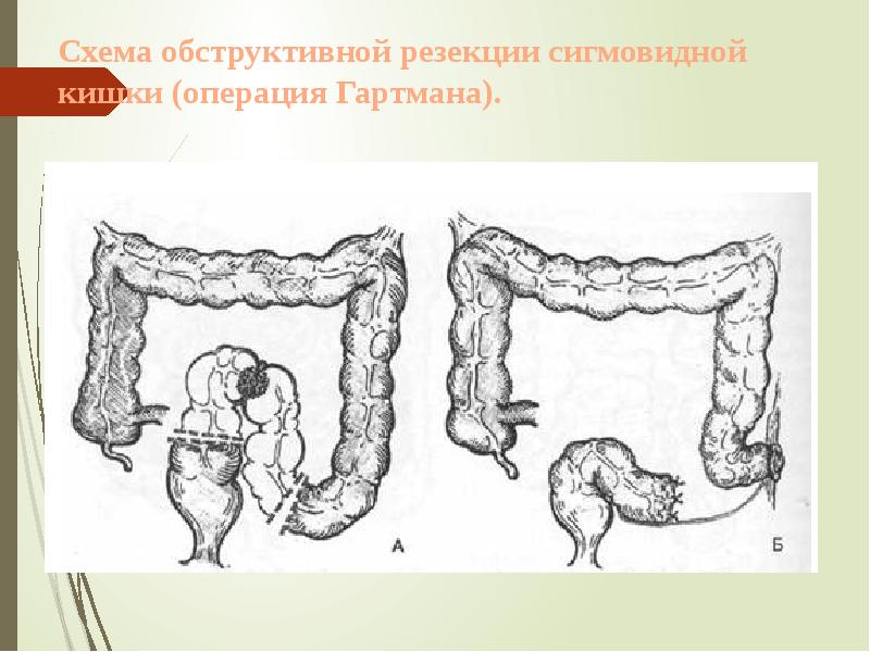Схема обструктивной резекции сигмовидной кишки (операция Гартмана). Схема обструктивной резекции сигмовидной кишки (операция Гартмана).
