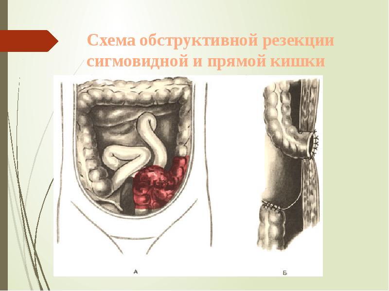 Схема обструктивной резекции сигмовидной и прямой кишки (операция Гартмана). Схема обструктивной резекции сигмовидной и прямой кишки (операция Гартмана).