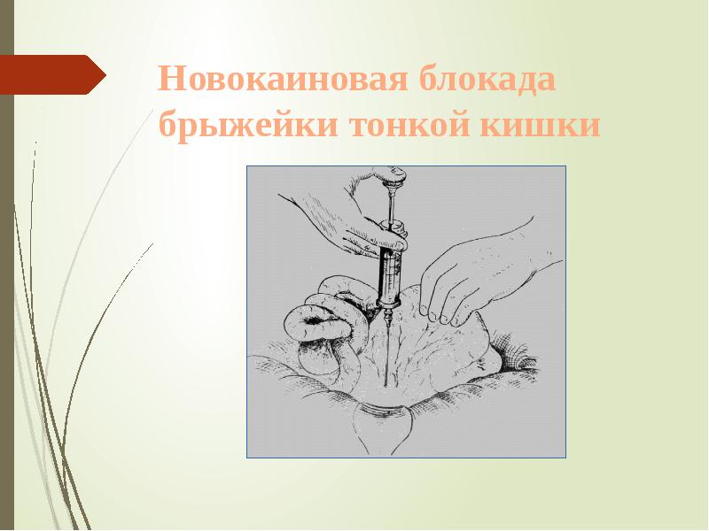Новокаиновая блокада брыжейки тонкой кишки Новокаиновая блокада брыжейки тонкой кишки