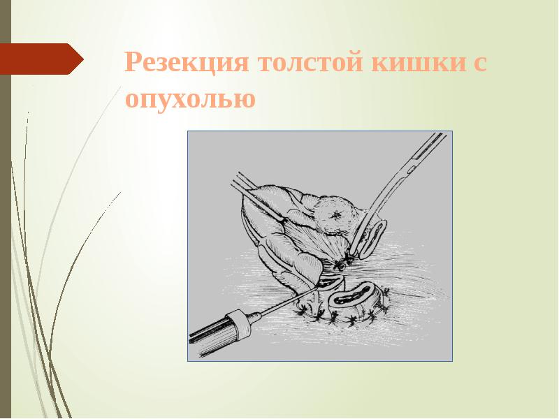 Резекция толстой кишки с опухолью Резекция толстой кишки с опухолью