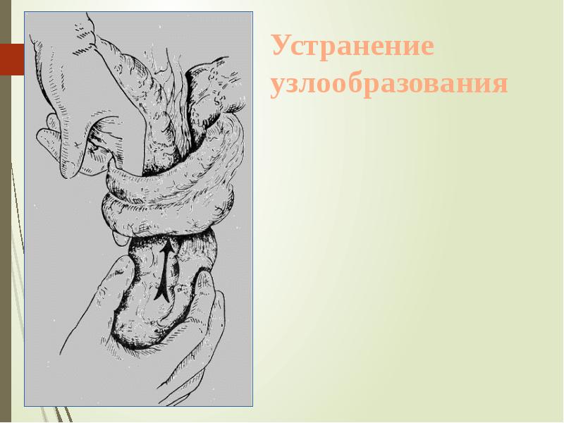 Устранение узлообразования Устранение узлообразования